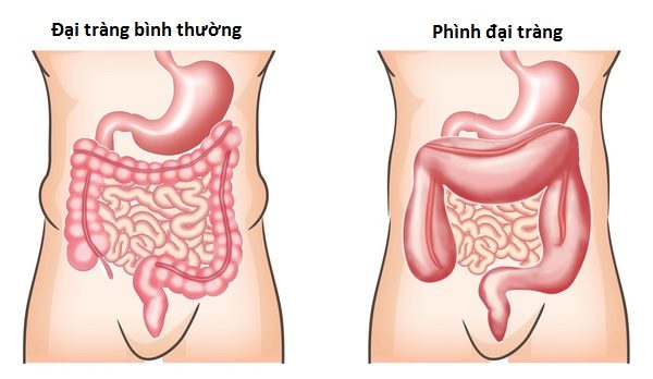 Phình đại tràng bẩm sinh - Hình ảnh minh họa